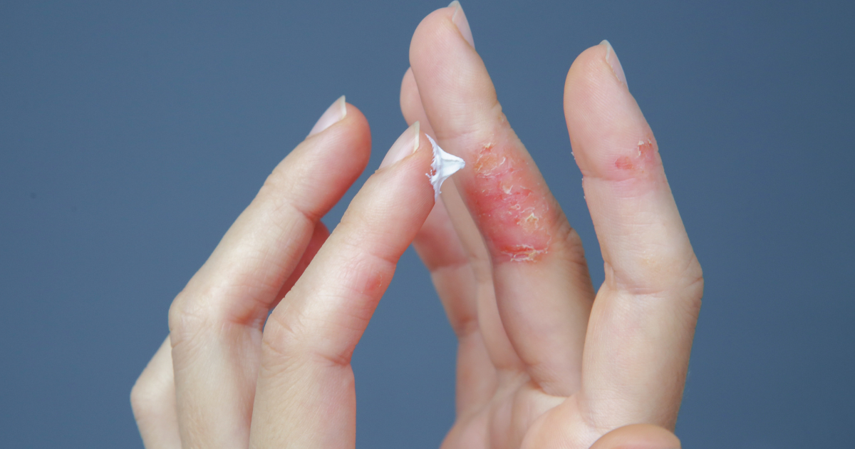 濕疹症狀怎麼判斷？醫師解析不同年齡與環境的典型表現