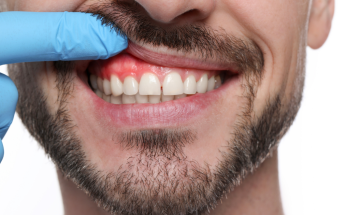 牙齦發炎怎麼辦？牙齦發炎別只漱口！成因、改善與全身健康影響一次整理給你