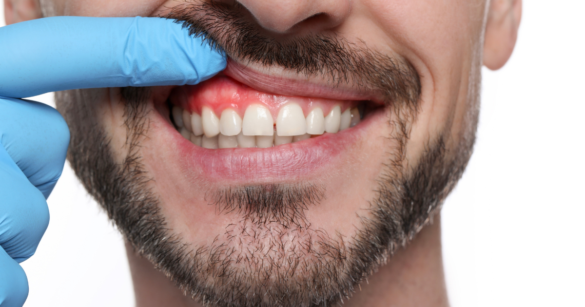 牙齦發炎怎麼辦？牙齦發炎別只漱口！成因、改善與全身健康影響一次整理給你