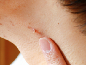 病毒疣是什麼？面對病毒疣怎麼辦？從原因解析到治療與預防的完整指南