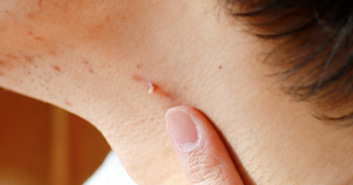 病毒疣是什麼？面對病毒疣怎麼辦？從原因解析到治療與預防的完整指南