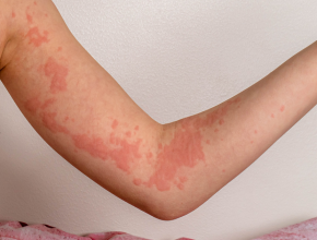 蕁麻疹怎麼來的？蕁麻疹反覆發作怎麼辦？成因、發作特徵與預防重點總整理