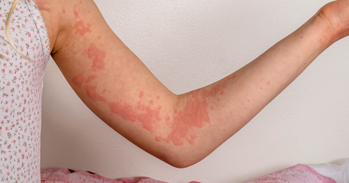 蕁麻疹怎麼來的？蕁麻疹反覆發作怎麼辦？成因、發作特徵與預防重點總整理