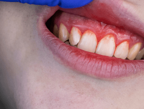 牙齦發炎腫脹完整指南：原因、處理方法與日常保養